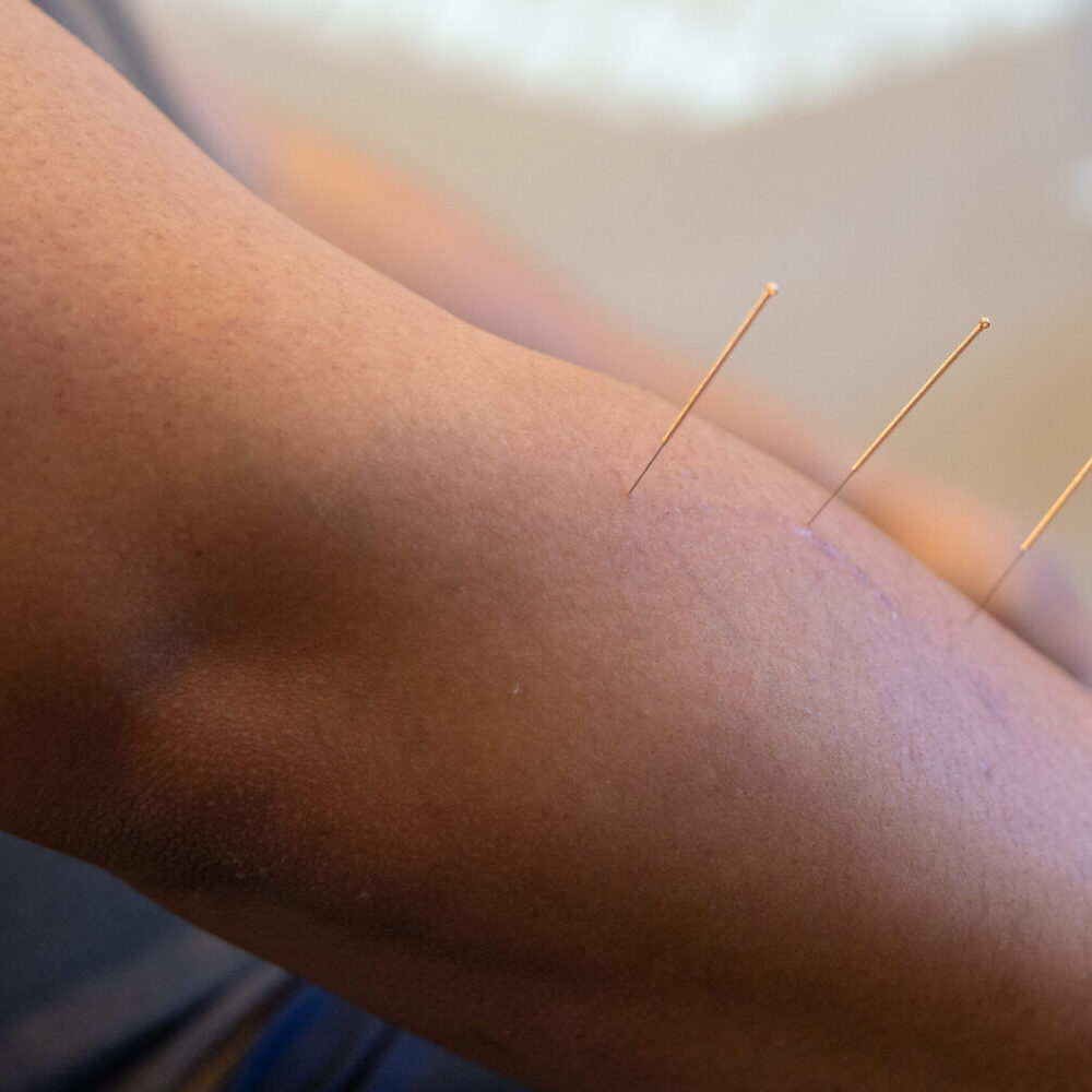 Country_Chiro_Dry_Needling